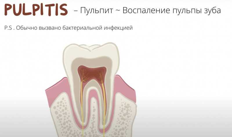 Сверление зуба как называется