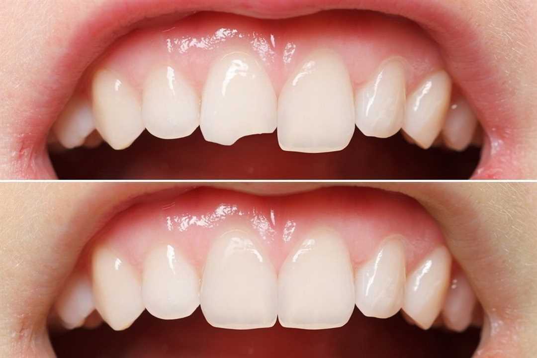 Схема реставраций при острой травме фронтальных зубов