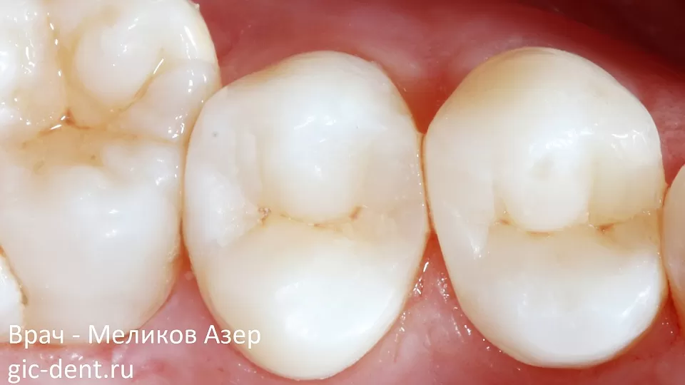 Подробный протокол прямой реставрации 6 передних зубов нижней челюсти