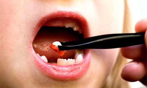 Сколько времени после удаления зуба может держаться температура