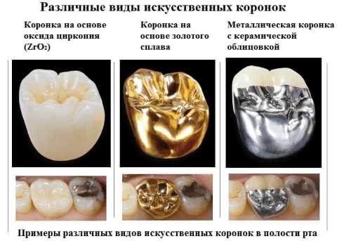 Коронка на зуб – технология изготовления, виды и результаты протезирования