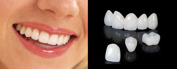 Отличие зубной коронки от пломбы