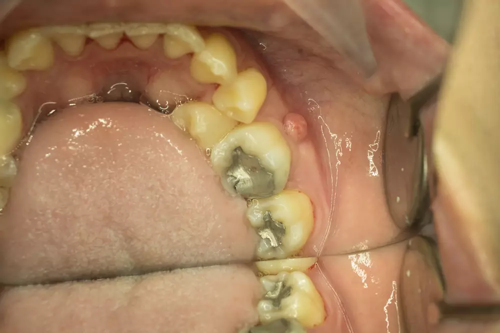 Через какое время можно приступить к восстановлению утраченного зуба?