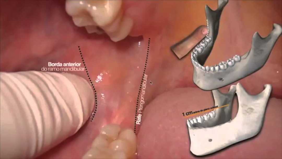 Резцовая анестезия инцизивная