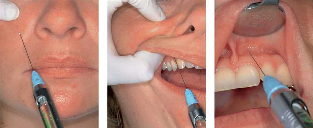 Точка зубов анестезия