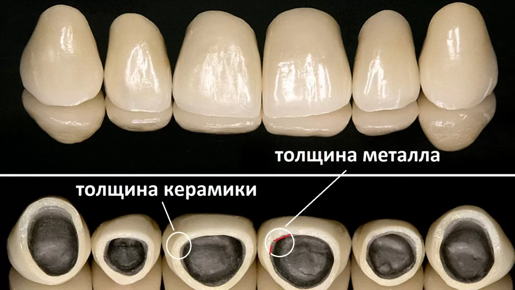 Первый фактор срока службы - толщина зубной коронки