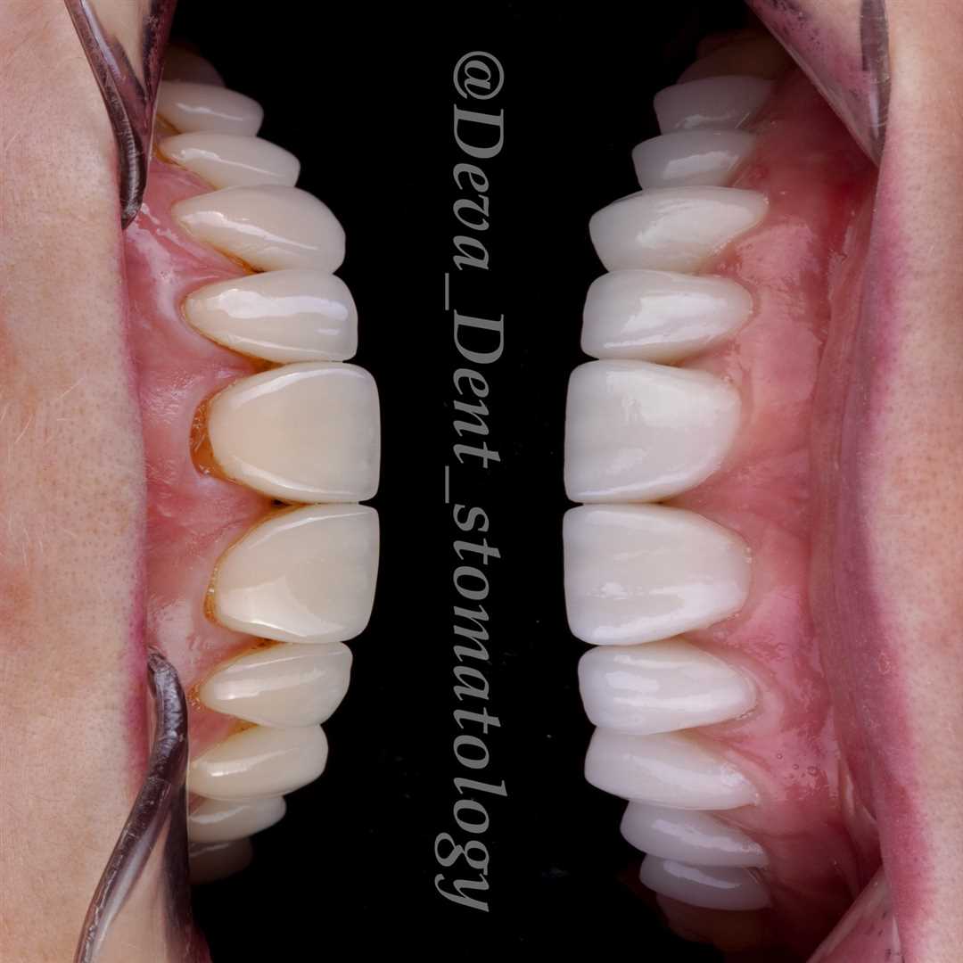 Тотальная реставрация зубов — восстановление и преображение улыбки без боли и дискомфорта