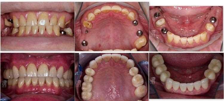 Тотальное протезирование зубов — восстановление здорового улыбку и полноценной жизни