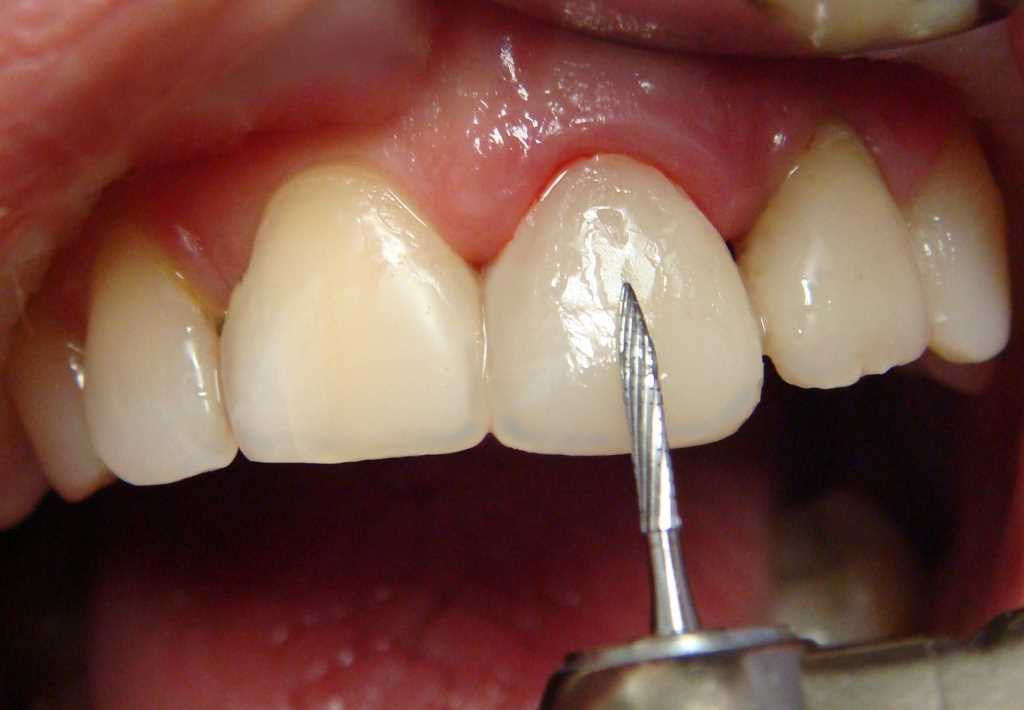 Преимущества художественной реставрации зубов: