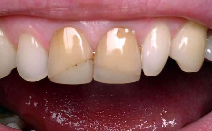 Методы реставрации трещины зуба — как вернуть здоровью и эстетическую привлекательность вашей улыбке