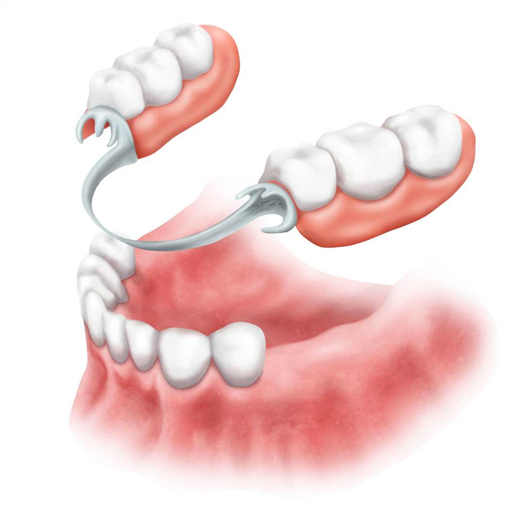 Импланты – как альтернатива протезированию зубов