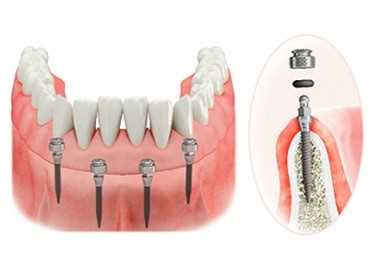 Стоимость создания цифровых протезов по технологии CADCAM в стоматологии Dental House в СПб