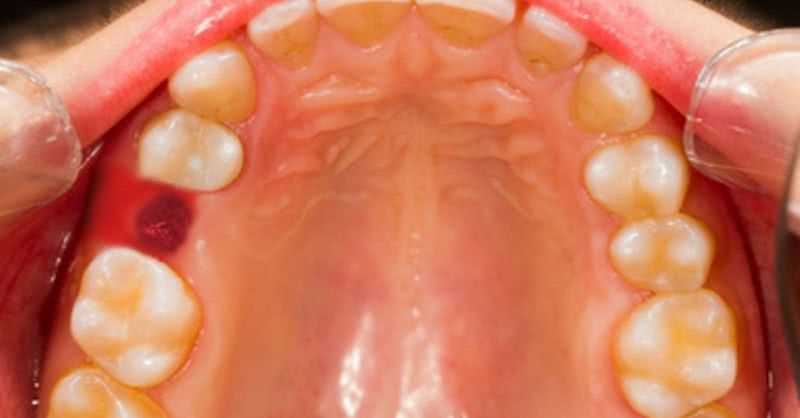 Как правильно проходит удаление 6 зуба без боли и осложнений
