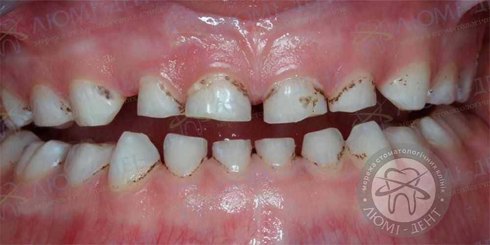 Профилактика черного налета на зубах