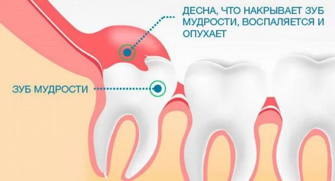 Удаление десны с зуба — причины, процедура и последствия