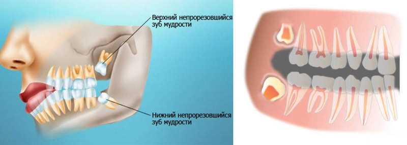 Современные методы и последствия удаления дистопированного зуба — особенности и рекомендации