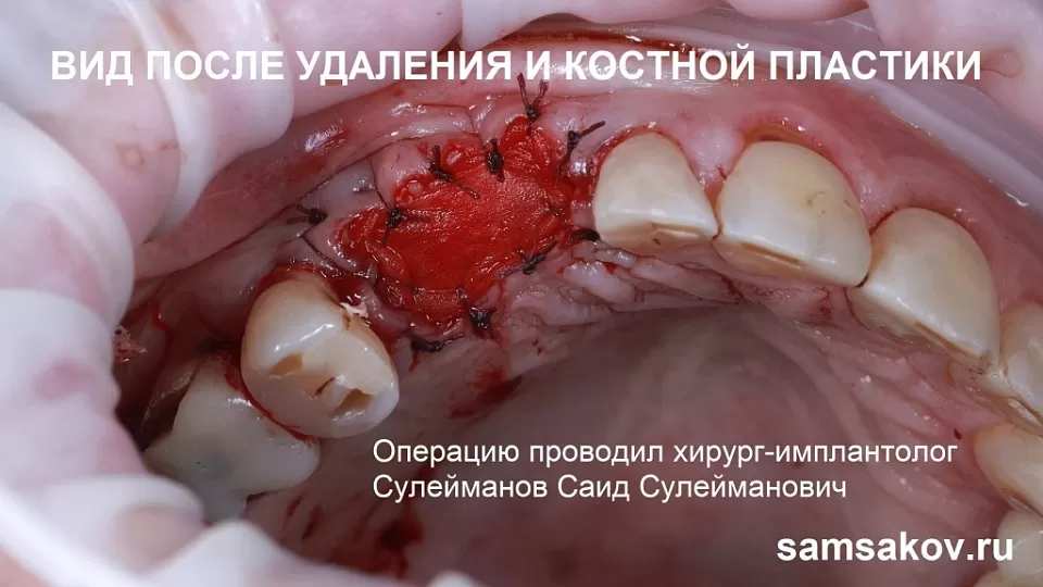 Лечение кисты без удаления зуба
