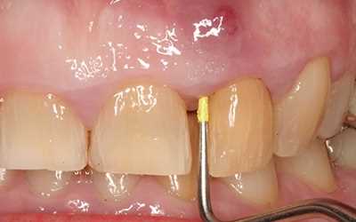 Удаление кисты зуба без удаления зуба