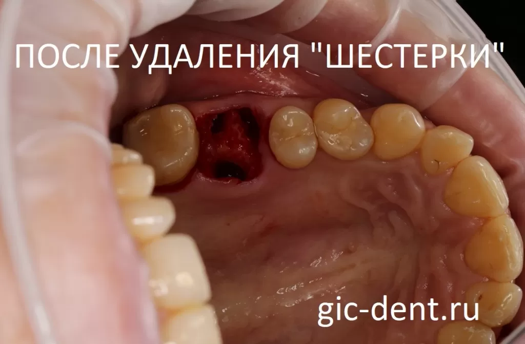 Преимущества удаления коренных зубов в Стоматологии Бескудниково в Москве