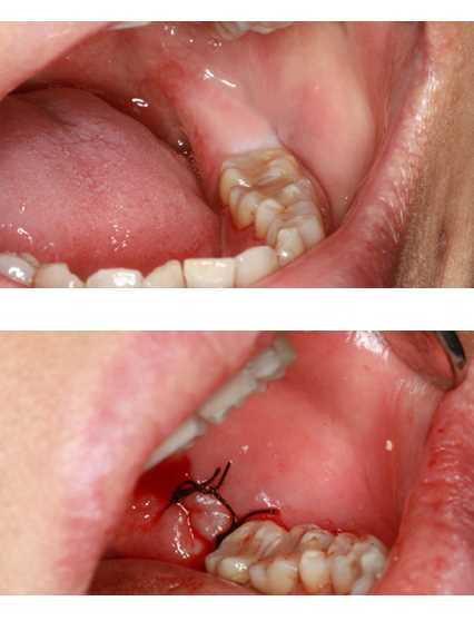 Больно ли удалять коренные зубы?