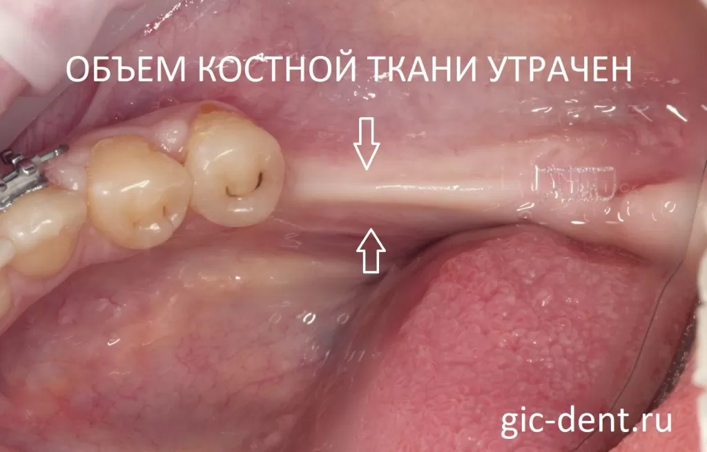 Удаление костной ткани зуба