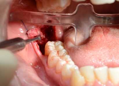 В каких случаях необходимо удаление зуба