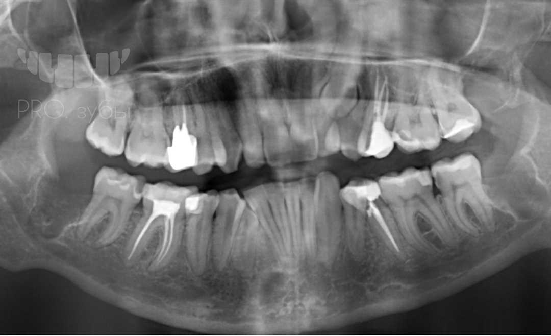 Удаление лежачих зубов — всё, что нужно знать о процедуре и последующей реабилитации