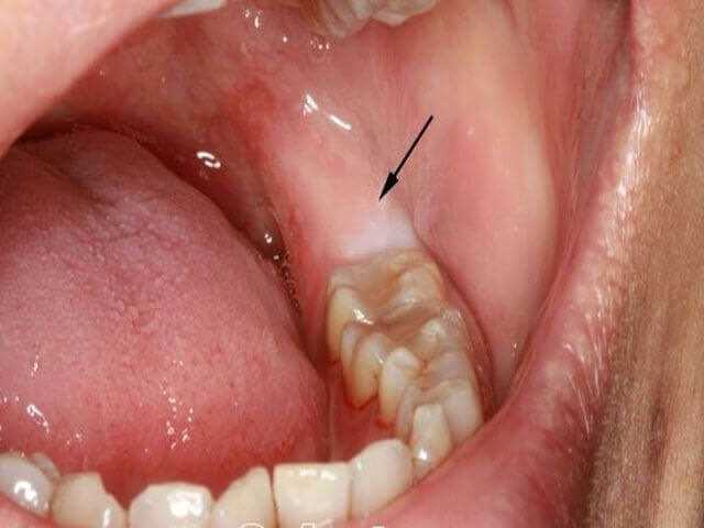 Срок заживления после удаления зуба