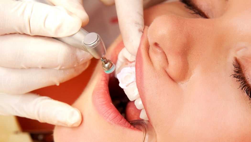 Как эффективно избавиться от мягкого зубного налета — полезные советы и проверенные методы удаления