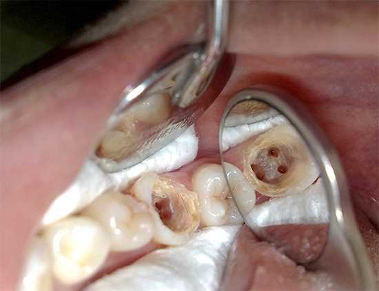 Как проводится удаление нерва зуба