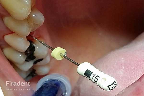 Показания и противопоказания к удалению нерва зуба