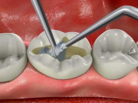 Удаление нерва зуба временная пломба