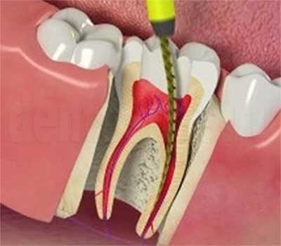 Как и зачем проводится удаление нерва зуба — все, что нужно знать