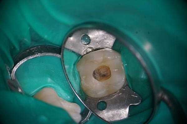 Преимущества атравматичного удаления зуба: