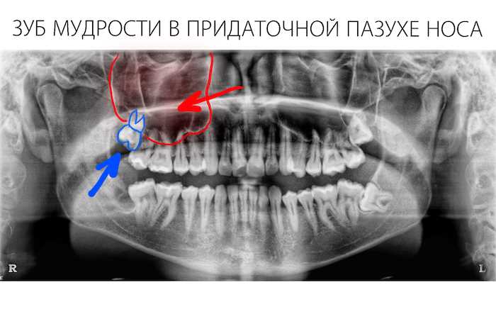Показания и противопоказания к атравматичному удалению зуба: