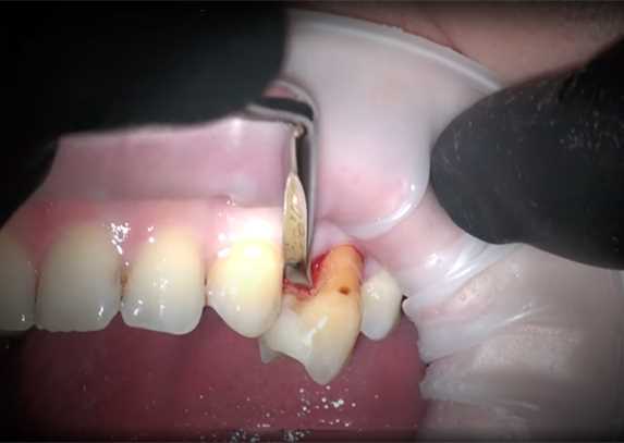 В чем заключается атравматичное удаление зубов