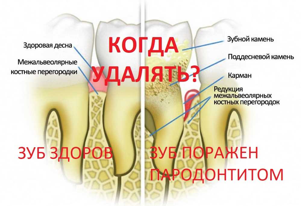 Процедура удаления перегородки зуба — все, что вам нужно знать