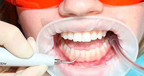 Удаление зубного камня
