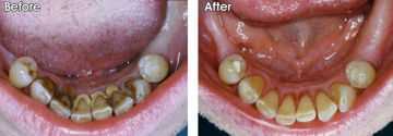 Снятие зубного камня и отложений