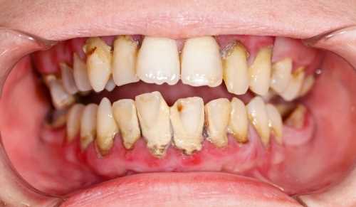 Удаление поддесневого зубного камня проводят эффективно и безболезненно с помощью современных методов