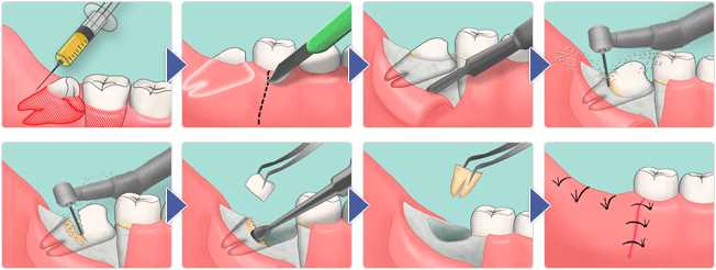 Причины, процесс и последствия удаления постоянного зуба
