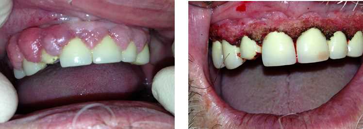 Как происходит удаление поврежденного зуба — основные этапы, виды анестезии и послеоперационный уход