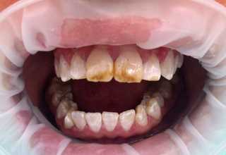 Как эффективно избавиться от пятен на зубах — эффективные методы удаления и профилактика