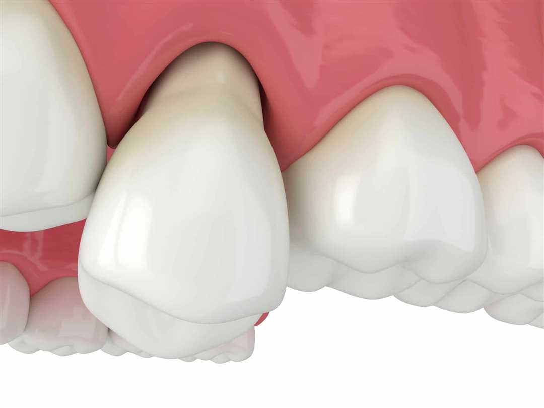 Как укрепить шатающийся зуб медикаментами?
