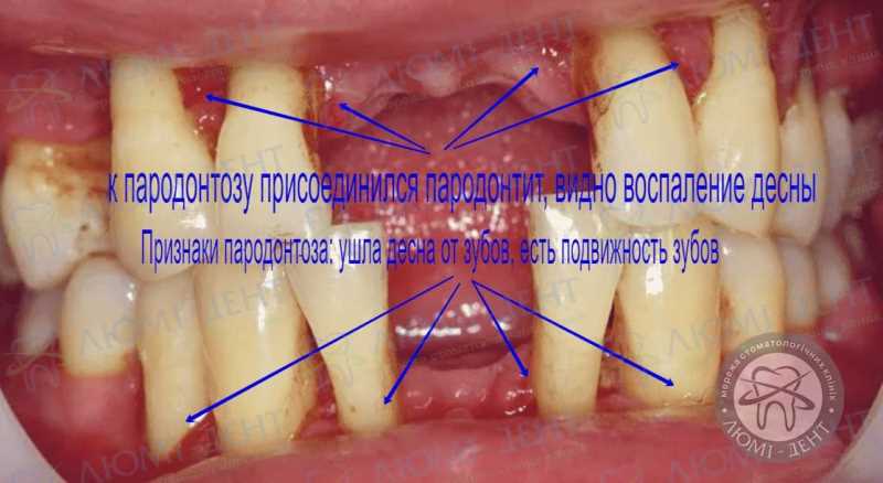 Степени подвижности коренных зубов