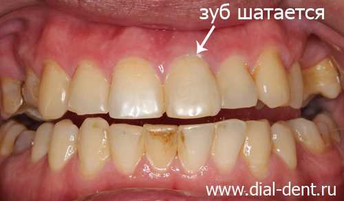Методы и последствия удаления сломанного зуба — причины, показания и процедура