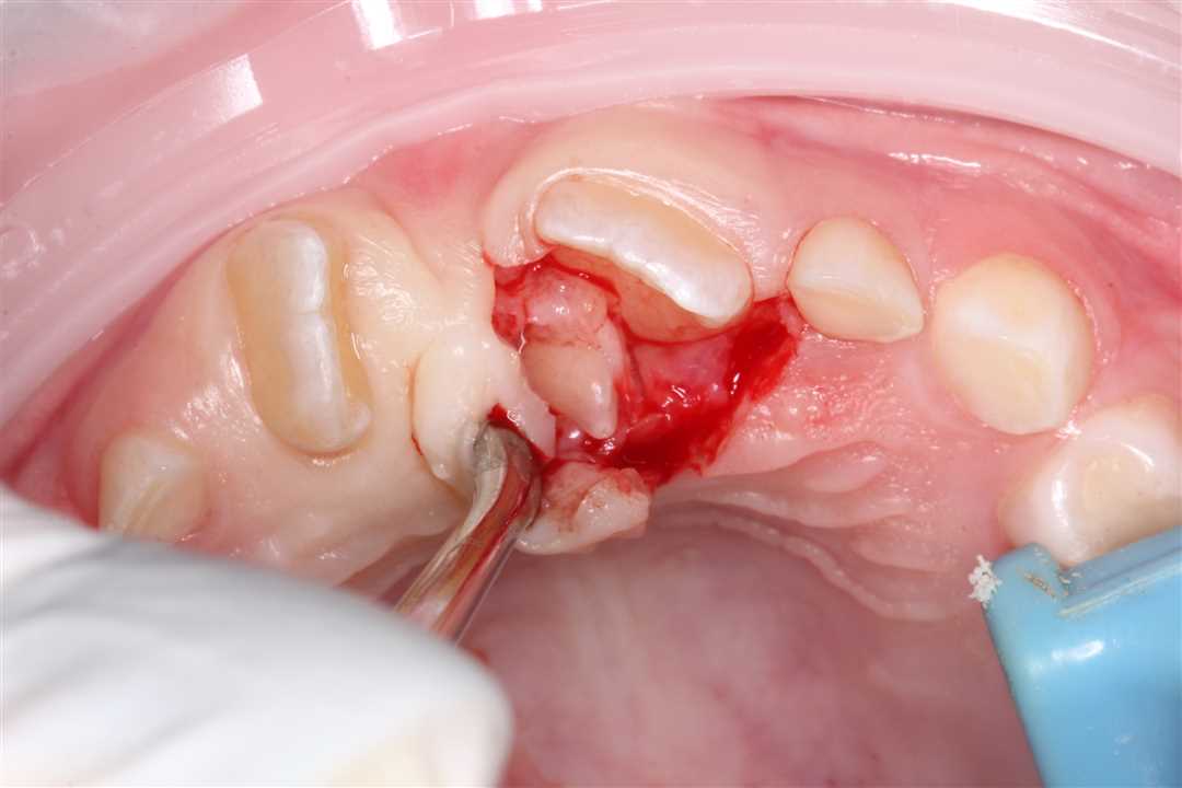 Удаление сверхкомплектных зубов