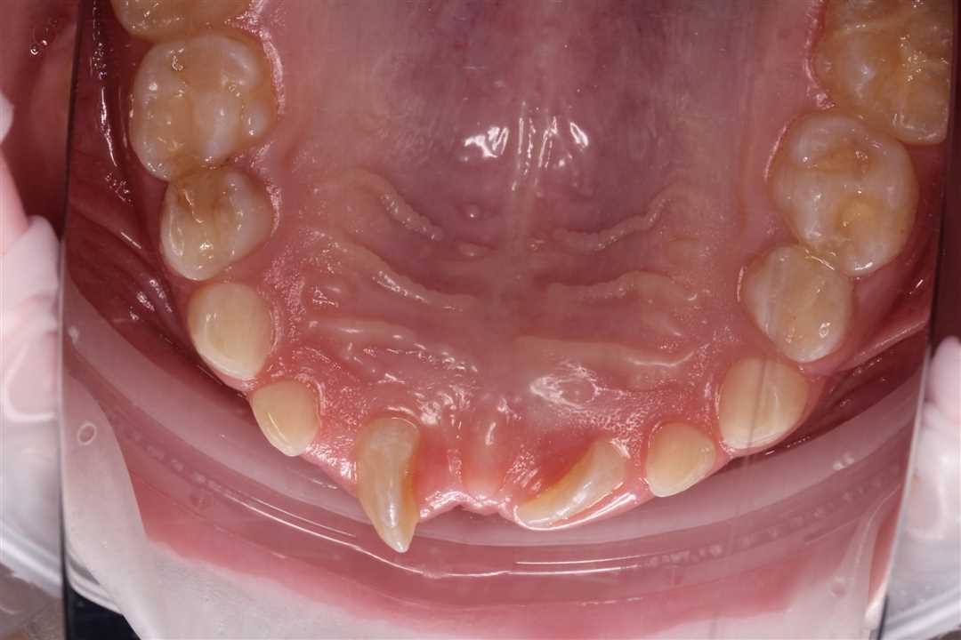 Оперативное удаление сверхкомплектного зуба — причины, последствия, рекомендации