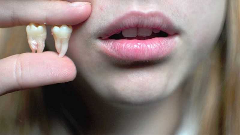 Показания для удаления экстракции зубов