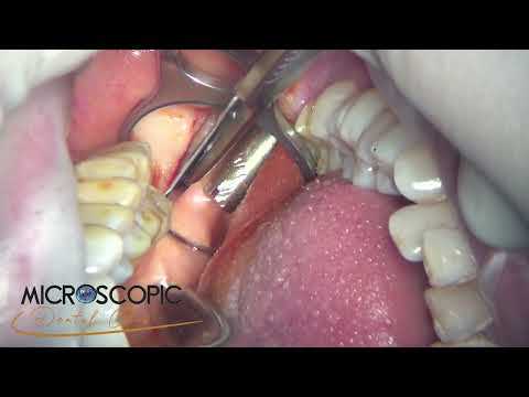 Удаление верхнего зуба мудрости — процедура, показания, последствия и реабилитация